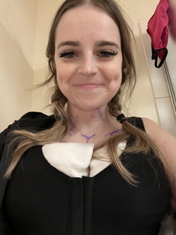 Woman with braided hair and purple markings on neck, wearing black top with white padding, smiling in a bathroom