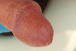 Close-up of a person's tongue against a white background.