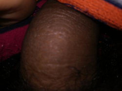 Close-up of a person's dark-skinned thigh with visible skin texture, partially covered by colorful fabric.